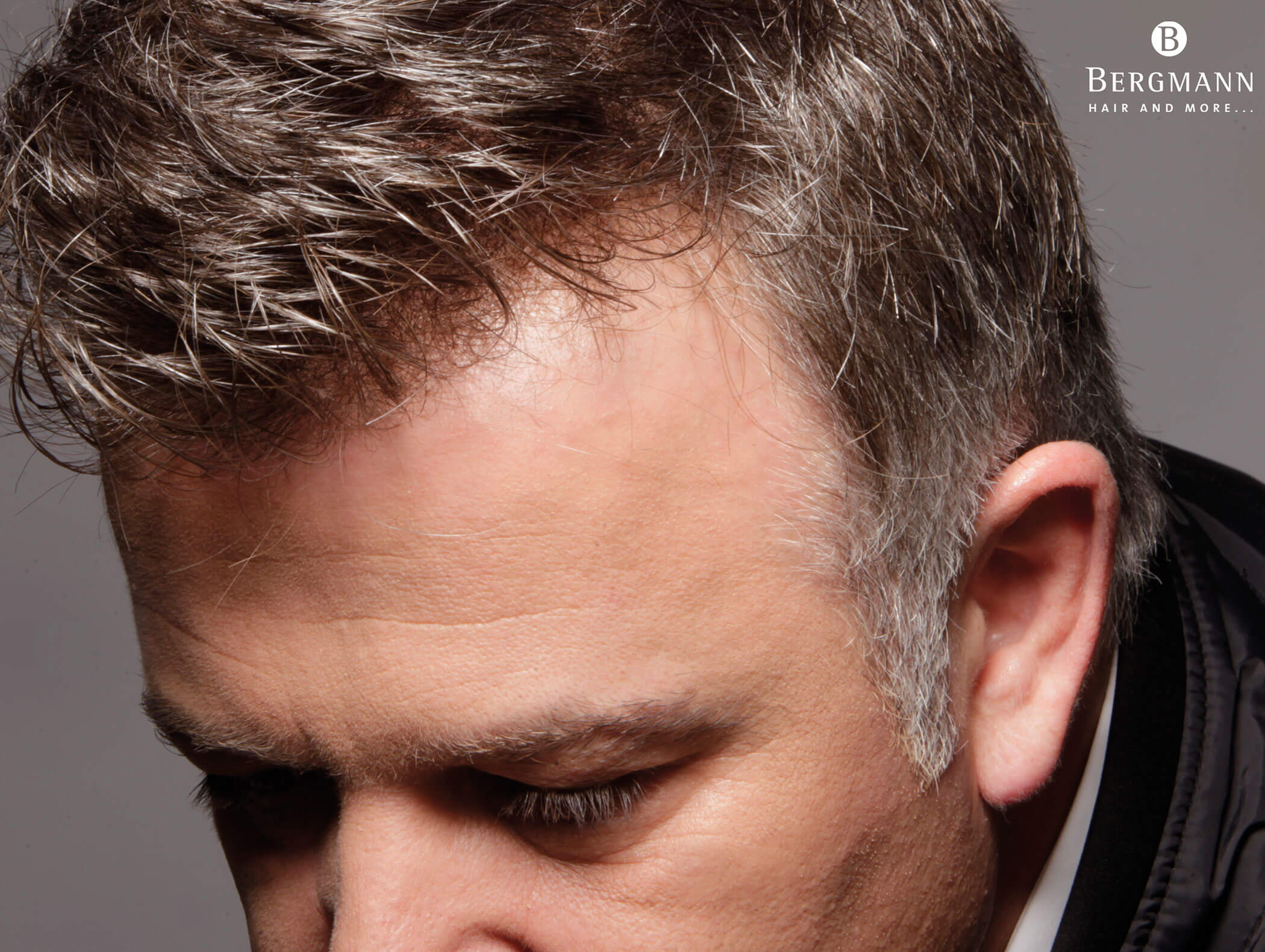 Trapianto di capelli - dettaglio di un uomo con capelli - Haarstudio Mayr a Brunico